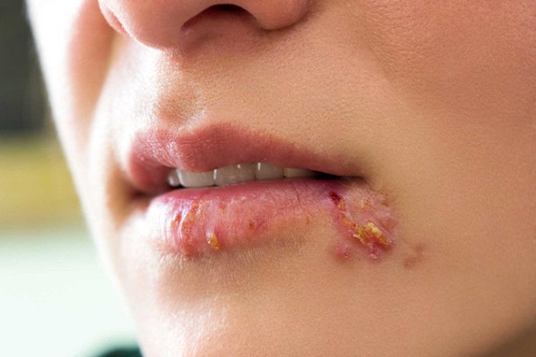 Những dấu hiệu nguy hiểm của bệnh lậu ở miệng